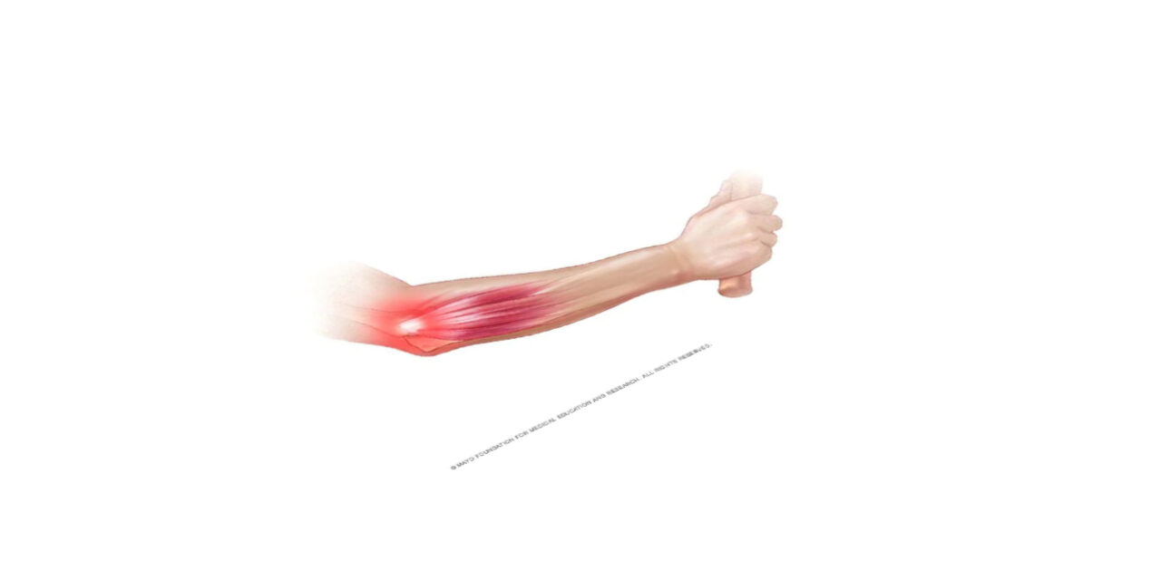 Everything You Need To Know About Tennis Elbow (Even If You Don’t Play Tennis)