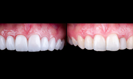 Unveiling Veneers