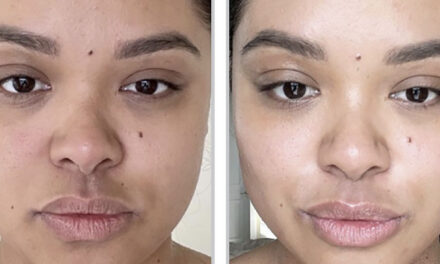 Discover the New Moxi Facial Treatment