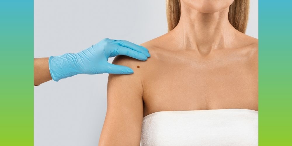 Key Strategies for Improving Outcomes in Melanoma